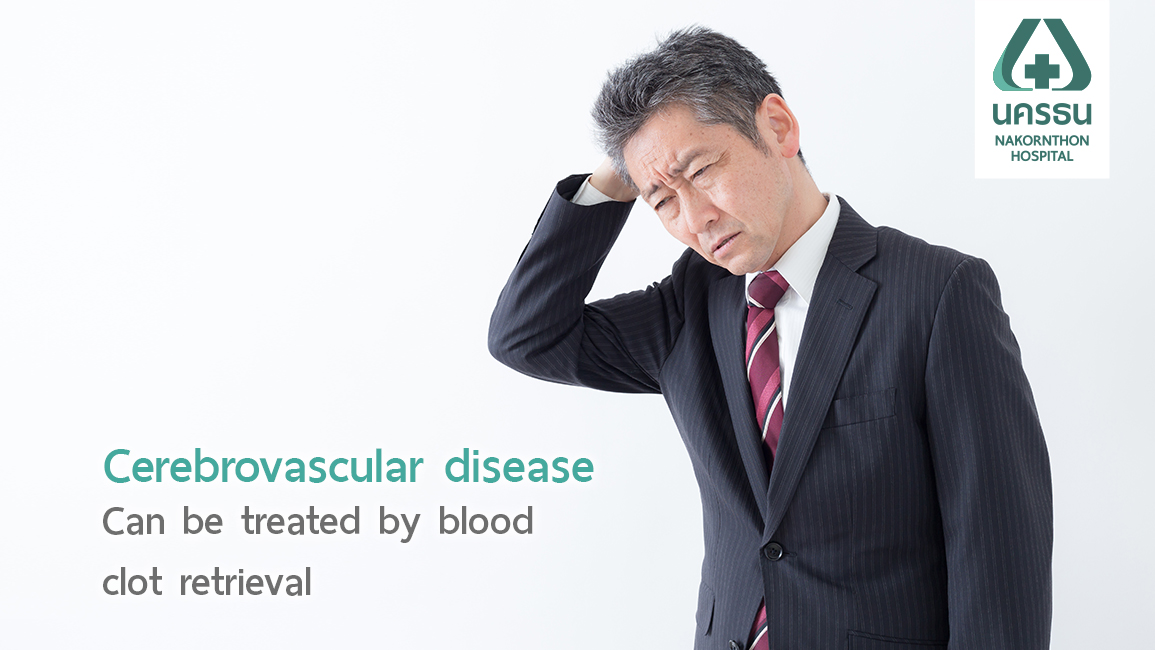 A catheter to retrieve blood clots, Treatment for ischemic stroke patients